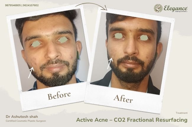 Active Makeover Face Makeover Gallery by Dr. Ashutosh, Surat
