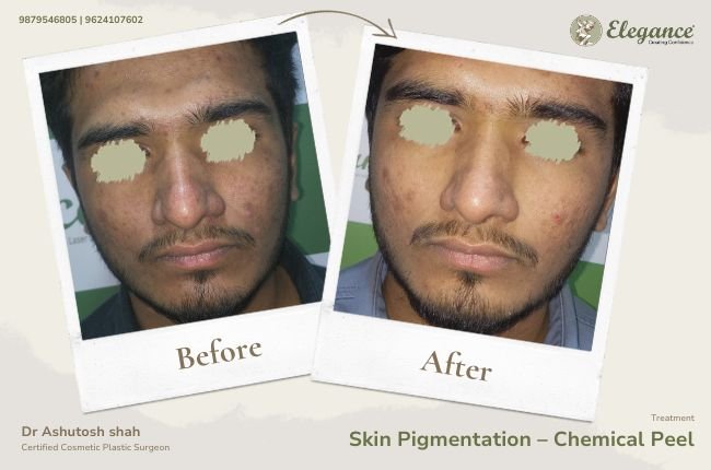 Active Makeover Face Makeover Gallery by Dr. Ashutosh, Surat