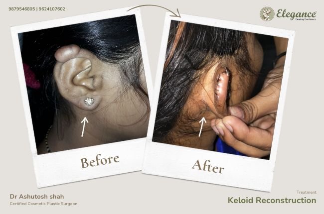 Keloid Before-After Gallery | Elegance Clinic Surat