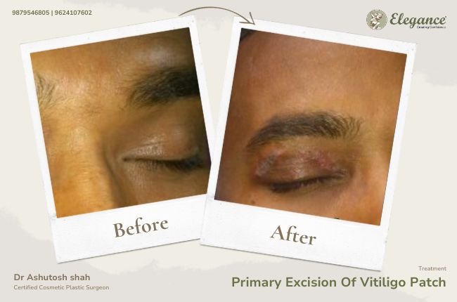 Vitiligo Before-After Gallery | Elegance Clinic Surat