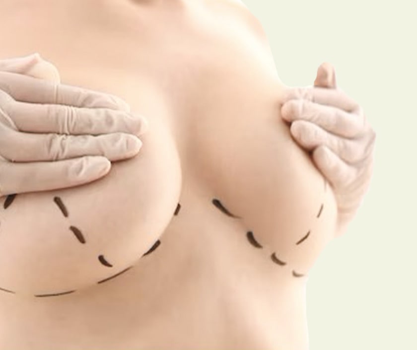 Areola Reduction