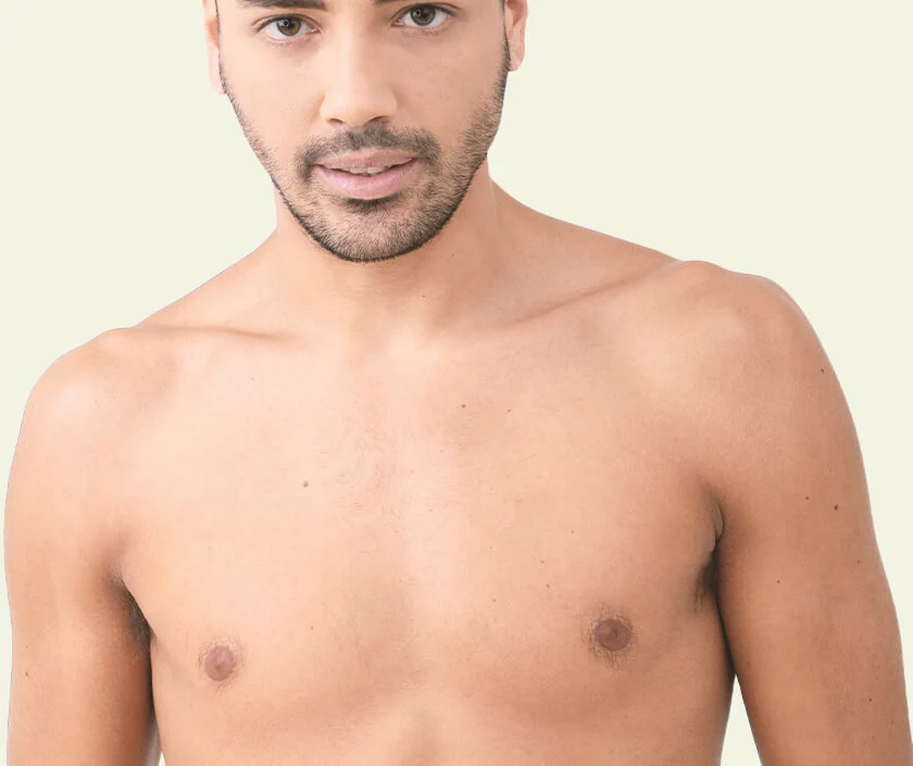 Type 2 Gynecomastia – Rounded Chest