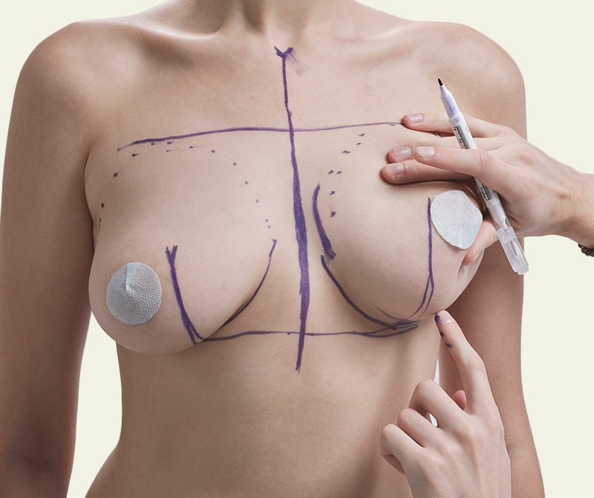 Breast Sagging Correction