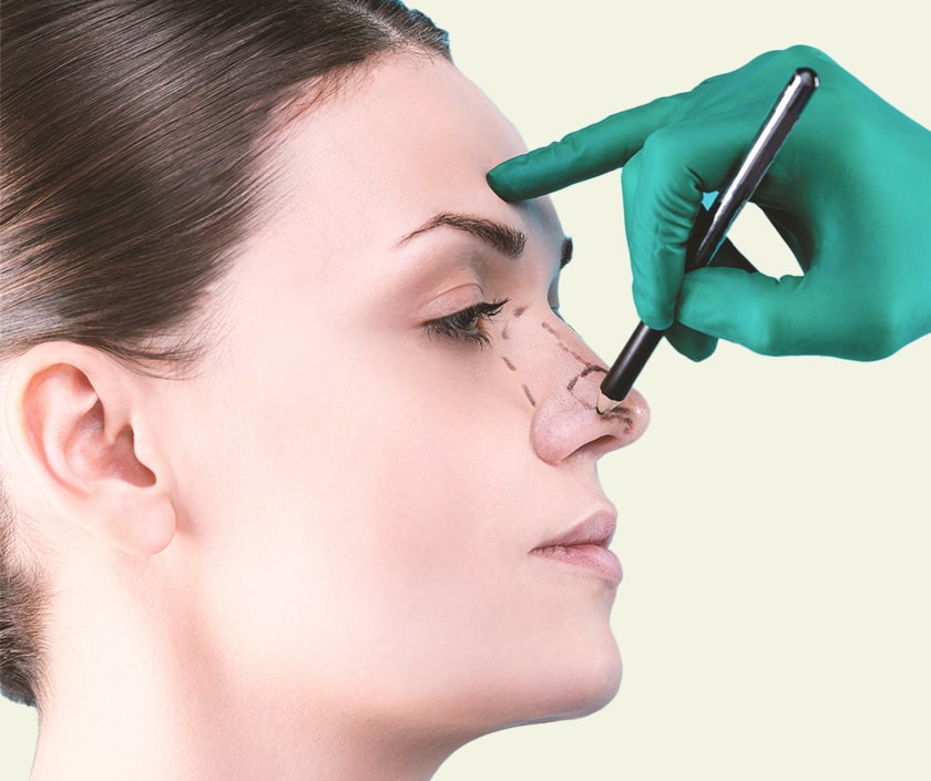 Nasal Dorsum Correction - Elegance Clinic