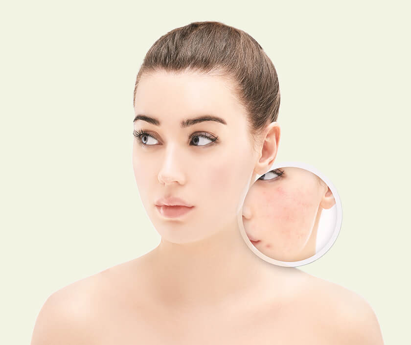 Acne Scar Management