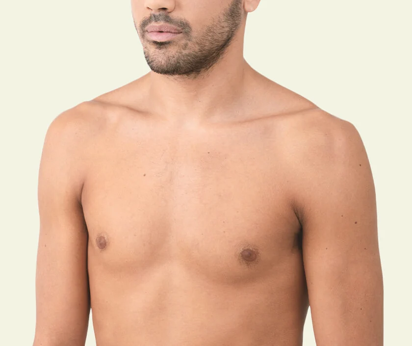 Type 4 Gynecomastia – Moderate Breast Roll