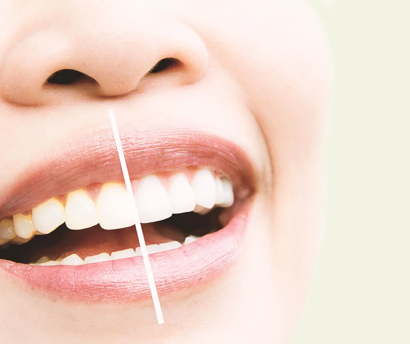 Teeth Whitening Or Teeth Bleaching