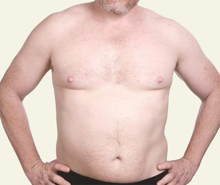 Asymmetric Gynecomastia