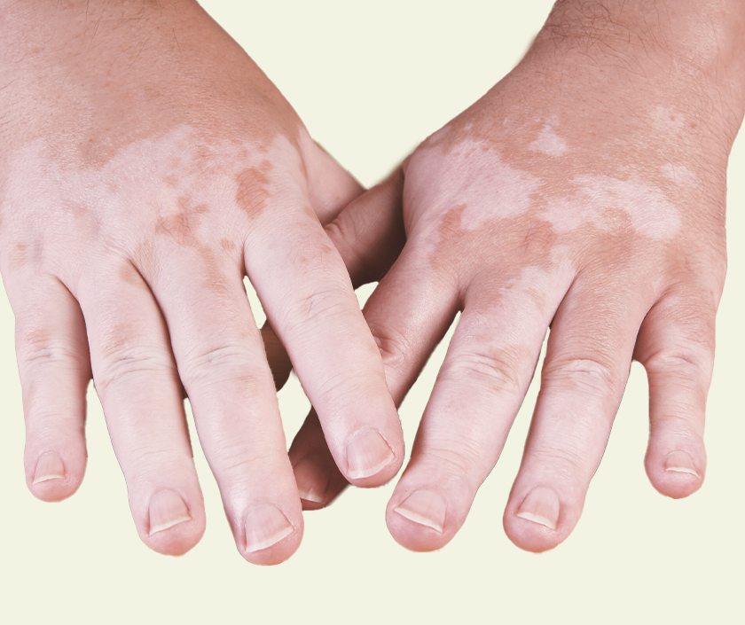 Blister Therapy For Vitiligo