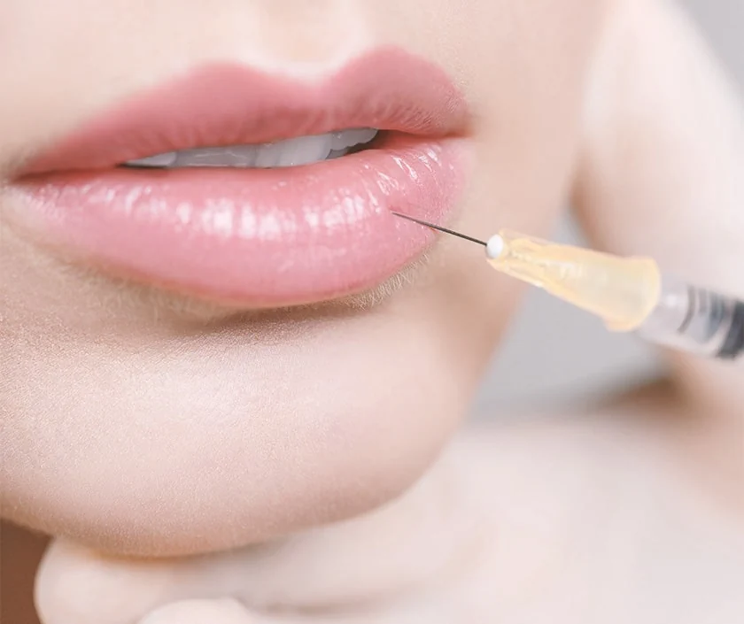 Fillers for Lip Augmentation