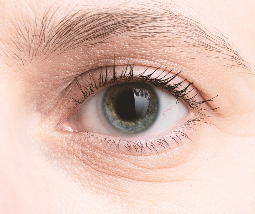 Lower Eyelids Wrinkles