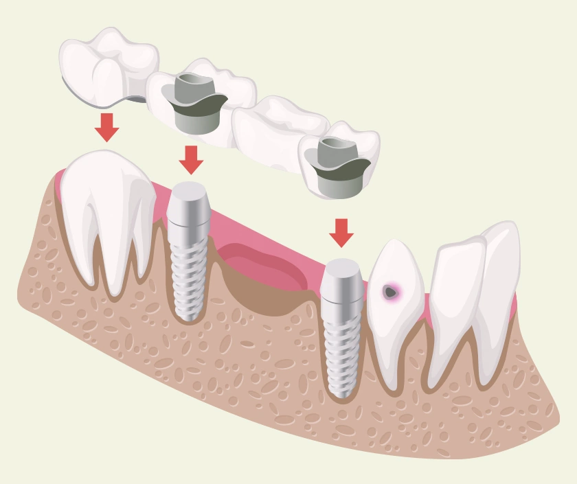 Dental Bridges