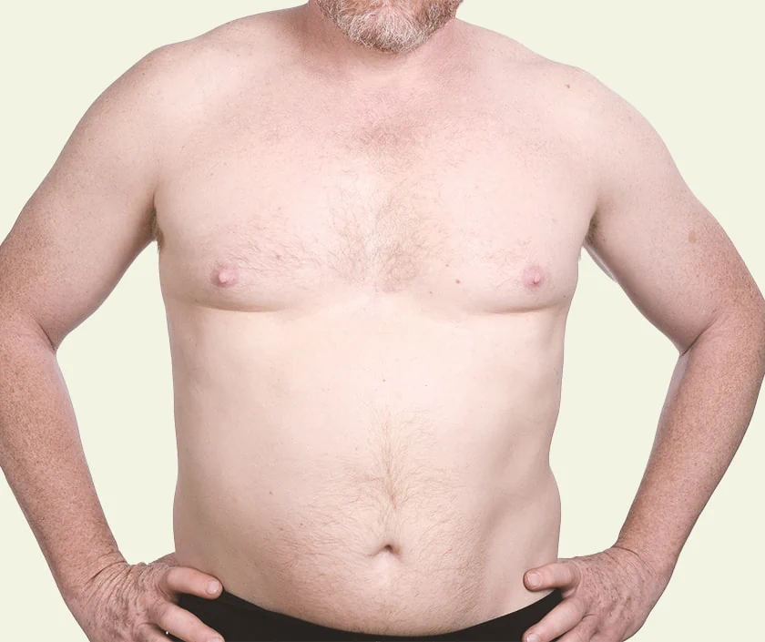 Pure Glandular Gynecomastia