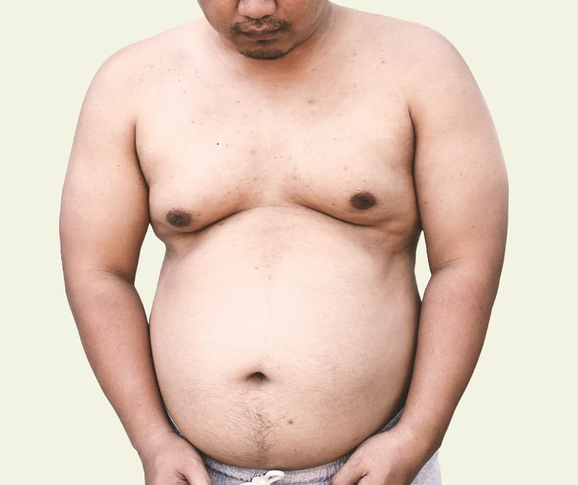 Pseudo Gynecomastia