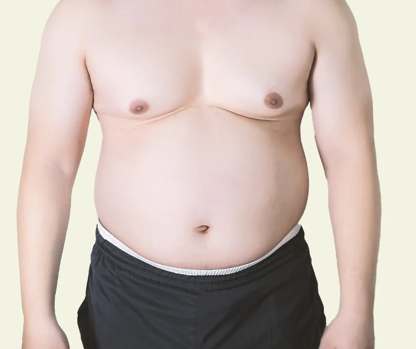 Grade 7 Gynecomastia Huge Female like Breasts