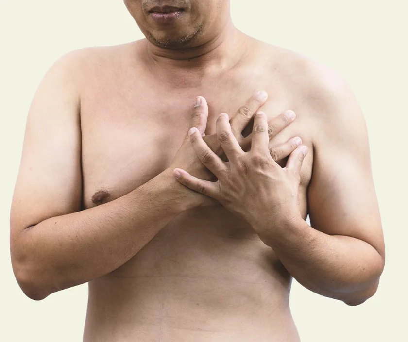 Adult Gynecomastia