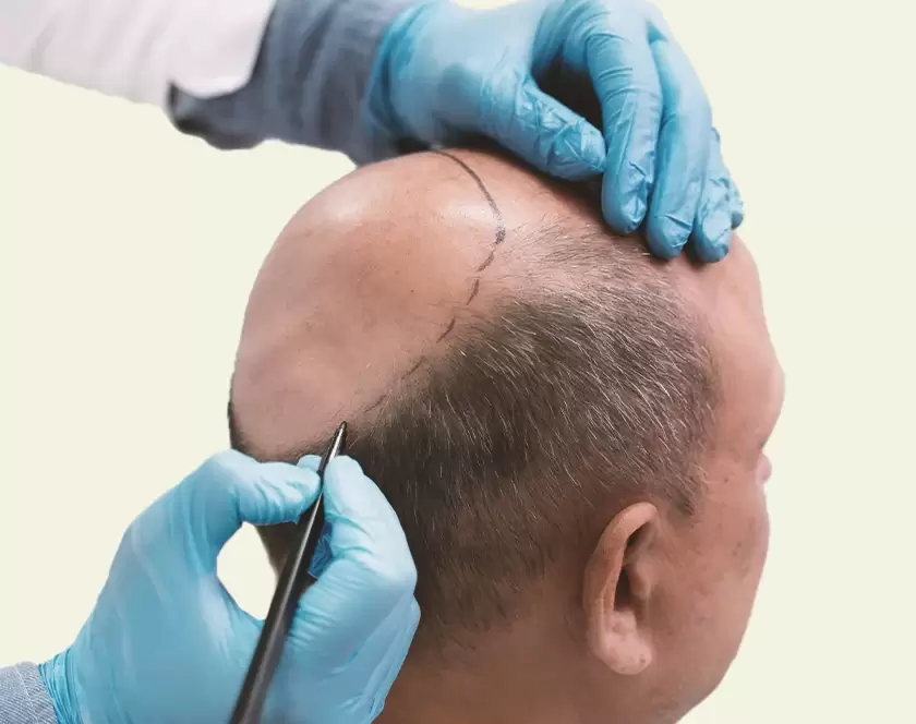 BIO-FUE Hair Transplant by Dr. Ashutosh Shah | Elegance Clinic