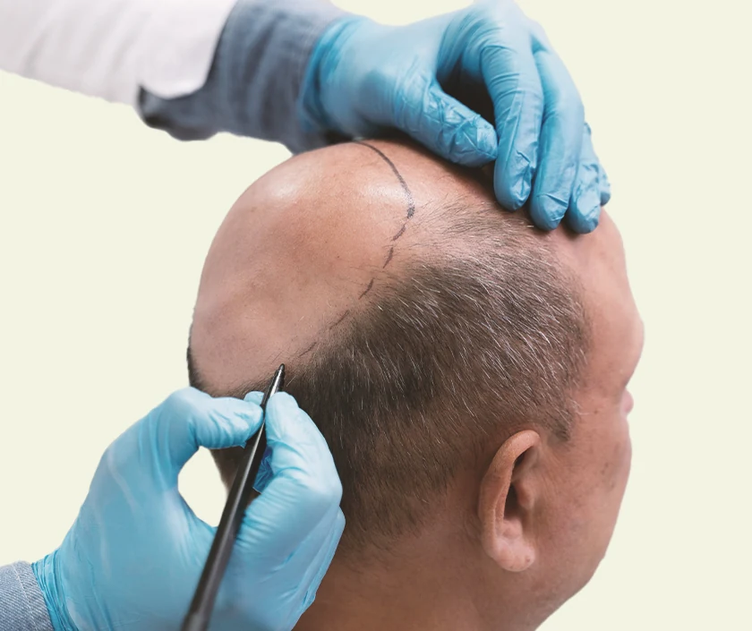 BIO-FUE Hair Transplantation