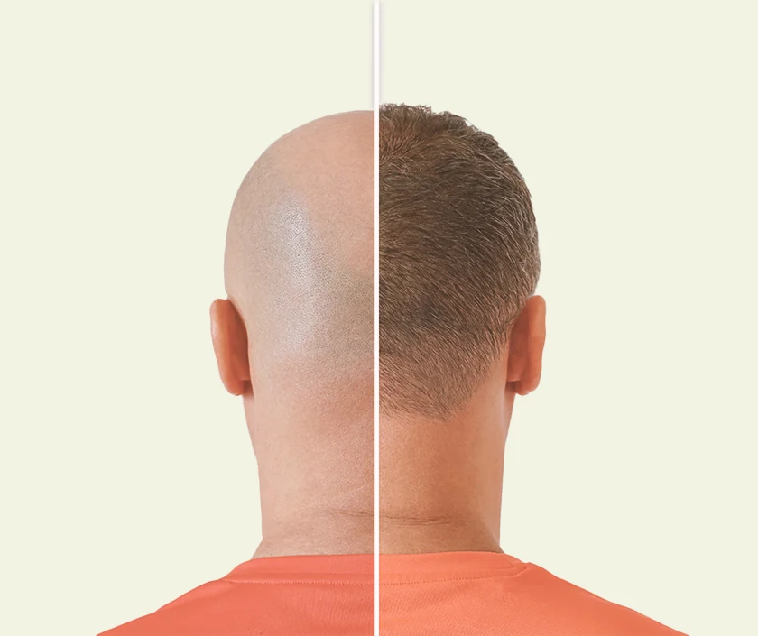 Combination Hair Transplant