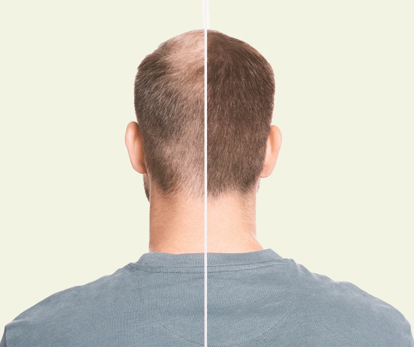 Hair Transplant For Larger Grad Baldness