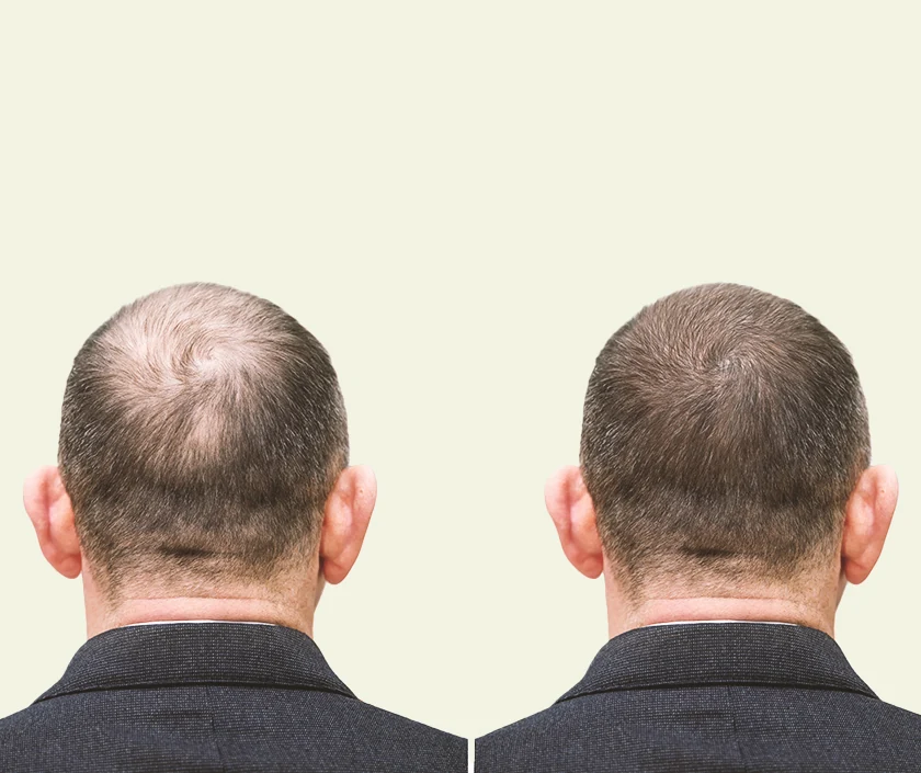 Hybrid Hair Transplant