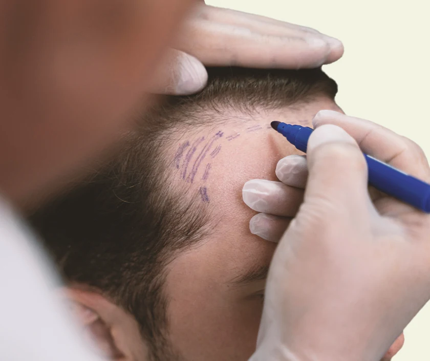 Revision Hair Transplant