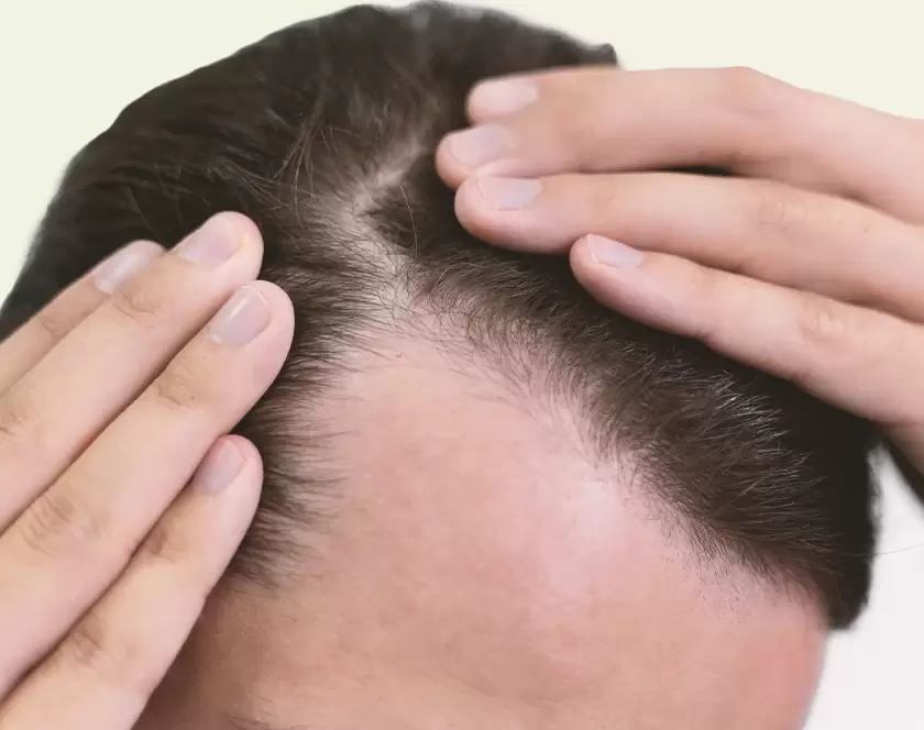 Hair Transplant in Scars by Dr. Ashutosh - Elegance Clinic