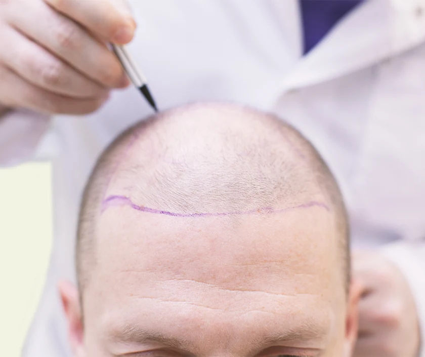 Hair Transplant without Shaving