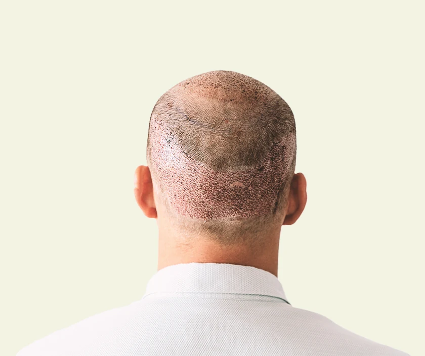 Hair Transplant for Vitiligo