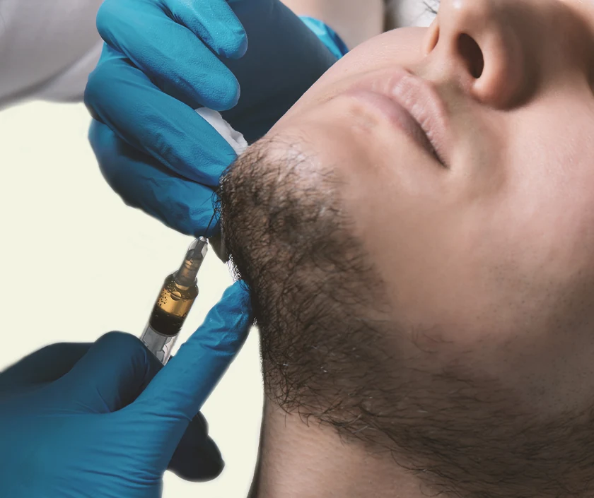 Beard Shaping with Hair Transplant