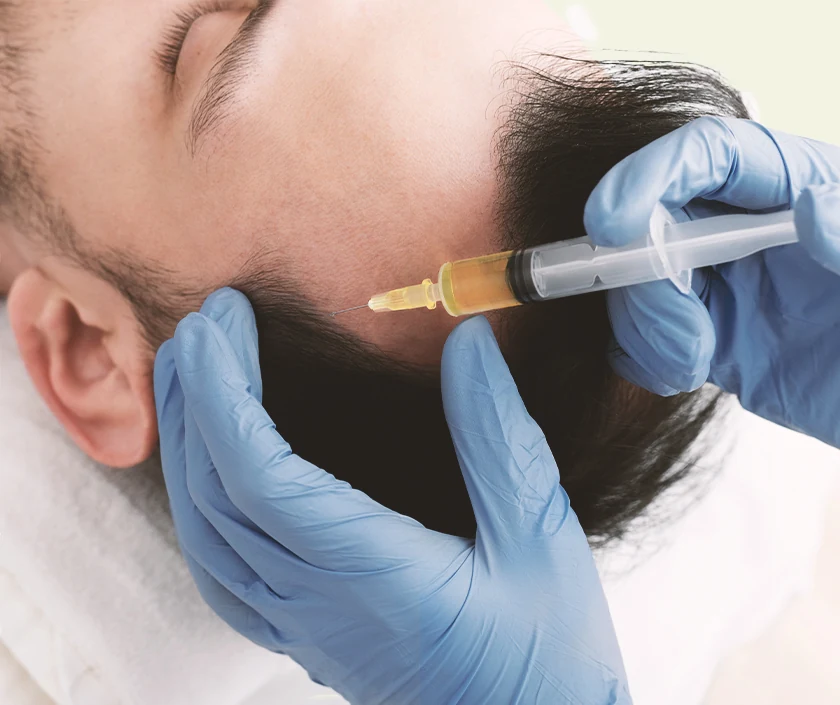 Hair Transplant – PRP