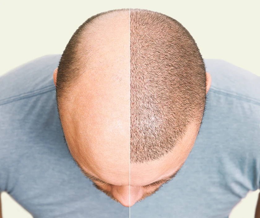 Scalp Micropigmentation