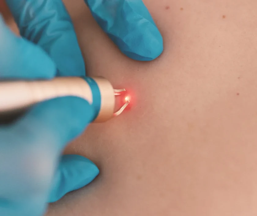 Laser For Keloid