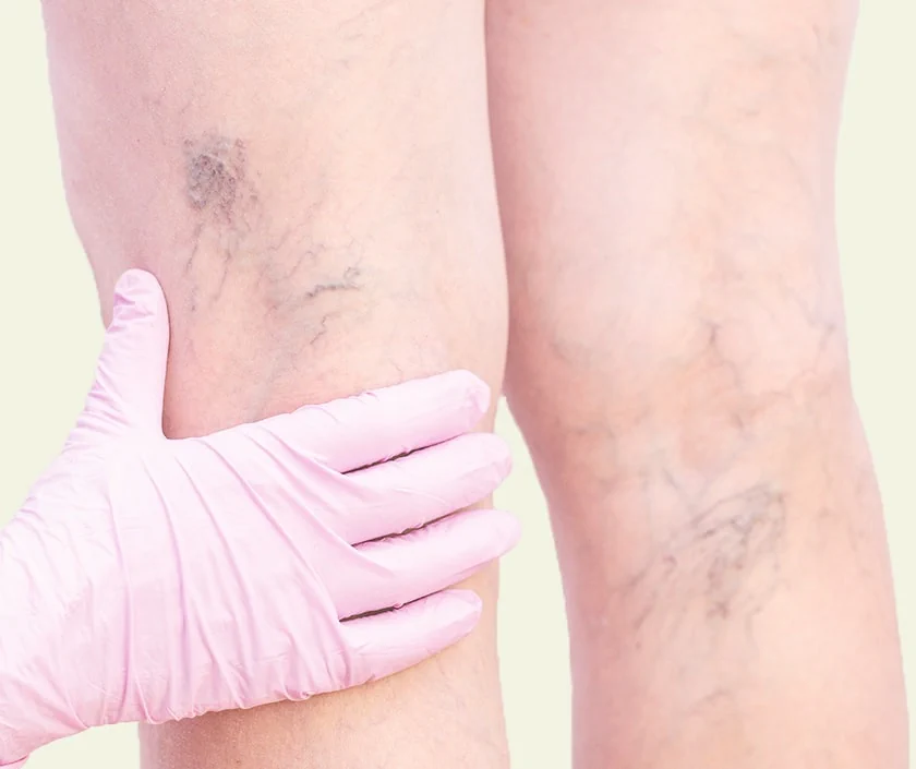 Laser Varicose Vein