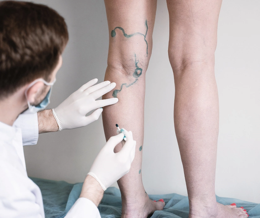 Sclerotherapy For Varicose Veins