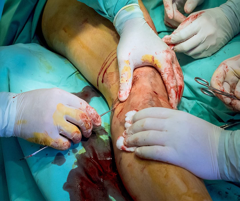 Subfascial Ligation For Varicose Veins