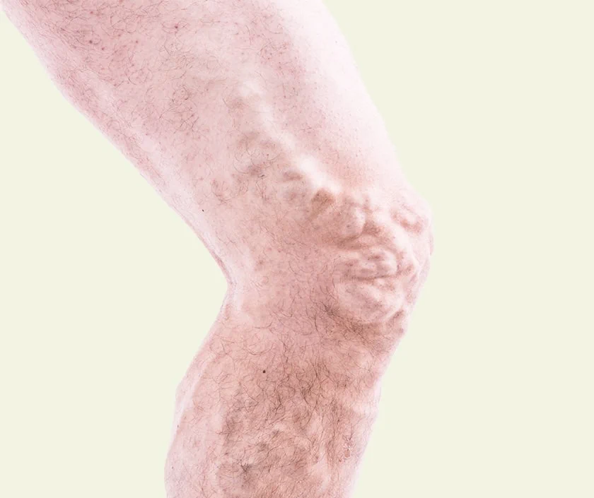 Varicose Veins Due To DVT