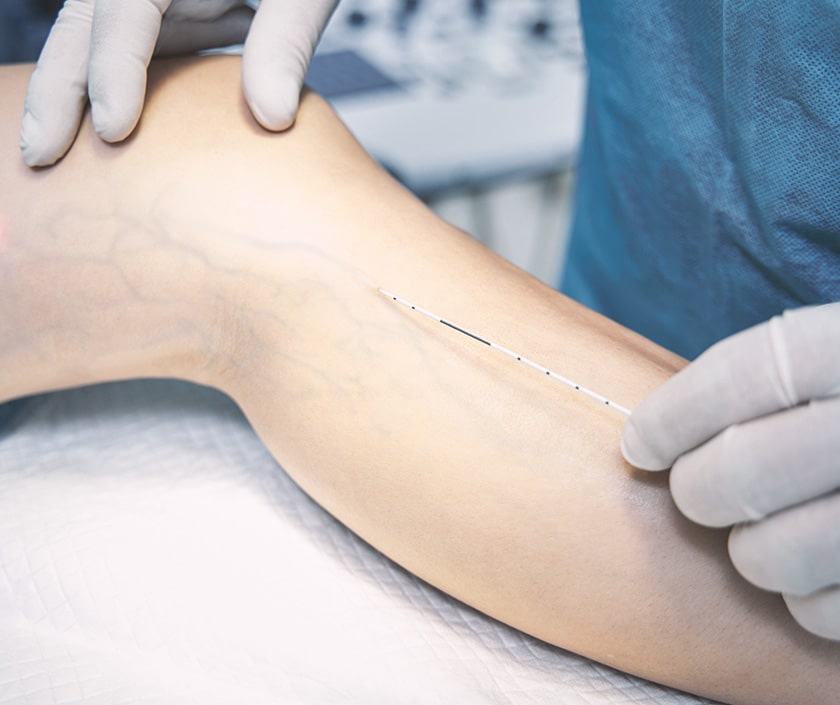 Laser For Varicose Veins