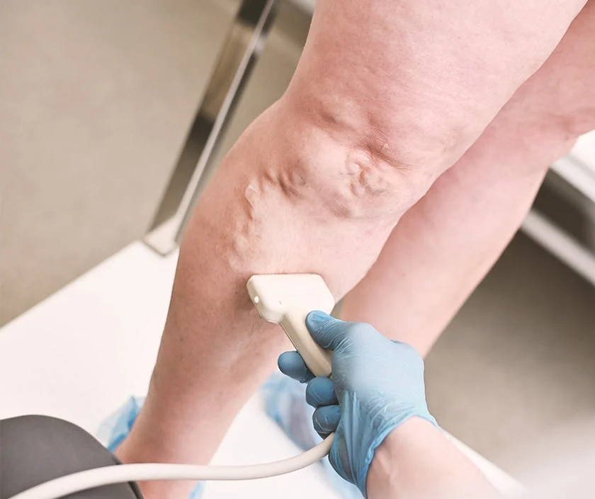 Radiofrequency For Varicose Veins