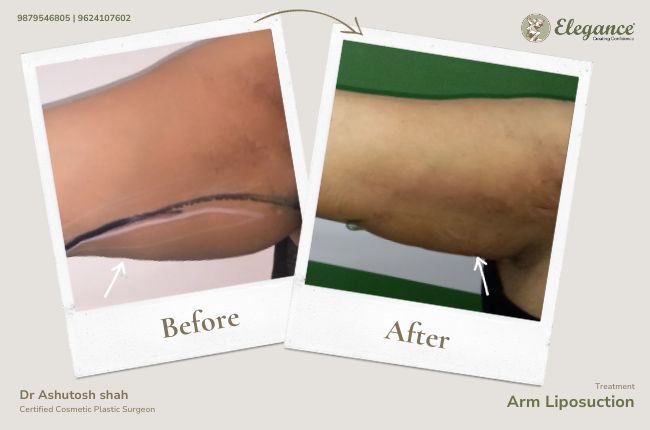 Arm Liposuction