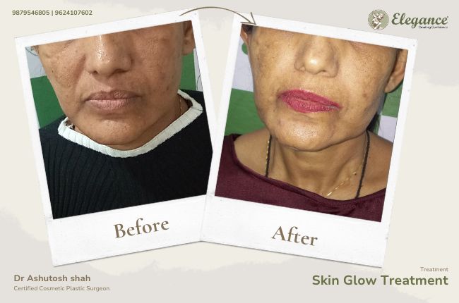 Skin Glow Treatment (3)