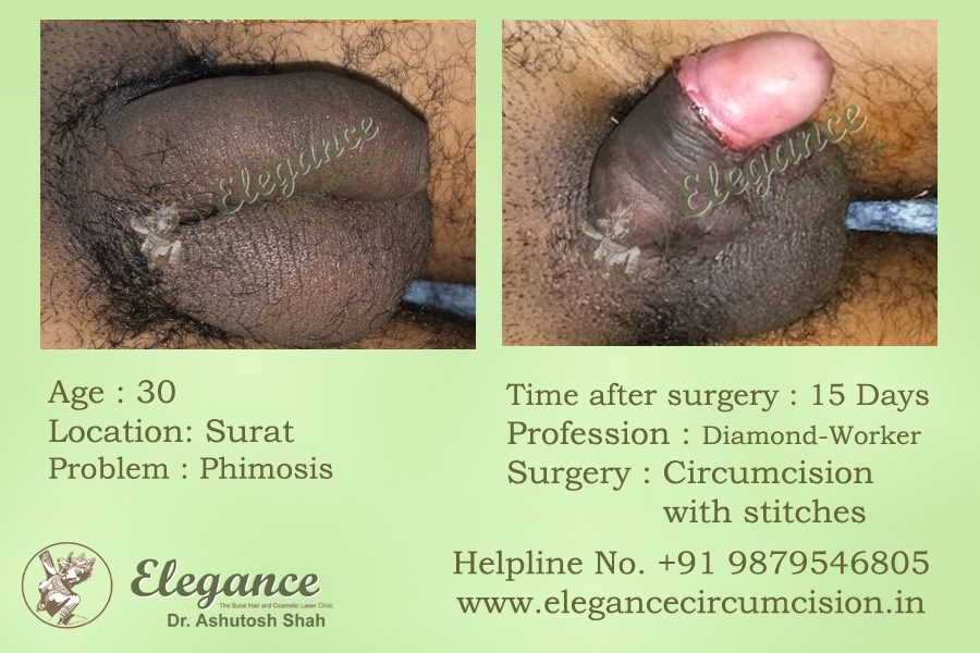 best-circumcision-in-surat