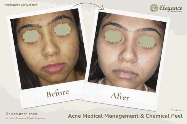 Acne Medical Management & Chemical Peel2