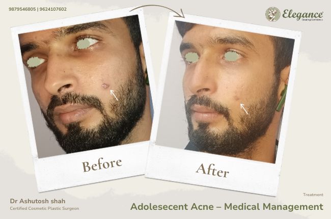 Adolesecent Acne GÇô Medical Management (2)