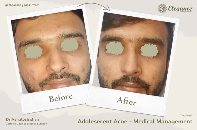 Adolesecent Acne – Medical Management