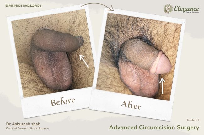 Advanced Circumcision Surgery (3)