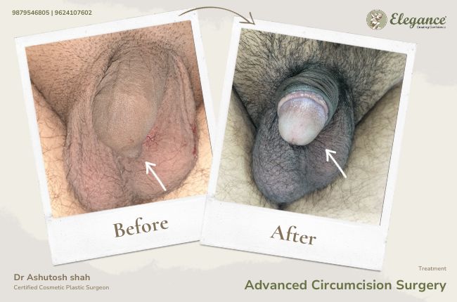 Advanced Circumcision Surgery (4)