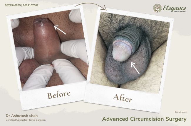 Advanced Circumcision Surgery (5)