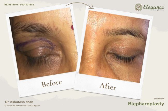 Blepharoplasty 2