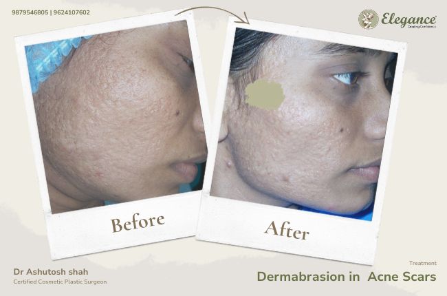 Dermabrasion in Acne Scars